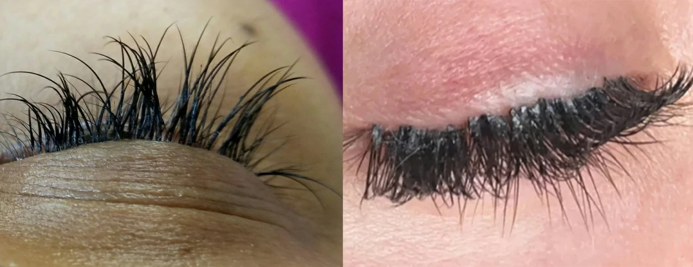 Poorly done lash extensions with clumping and irritation